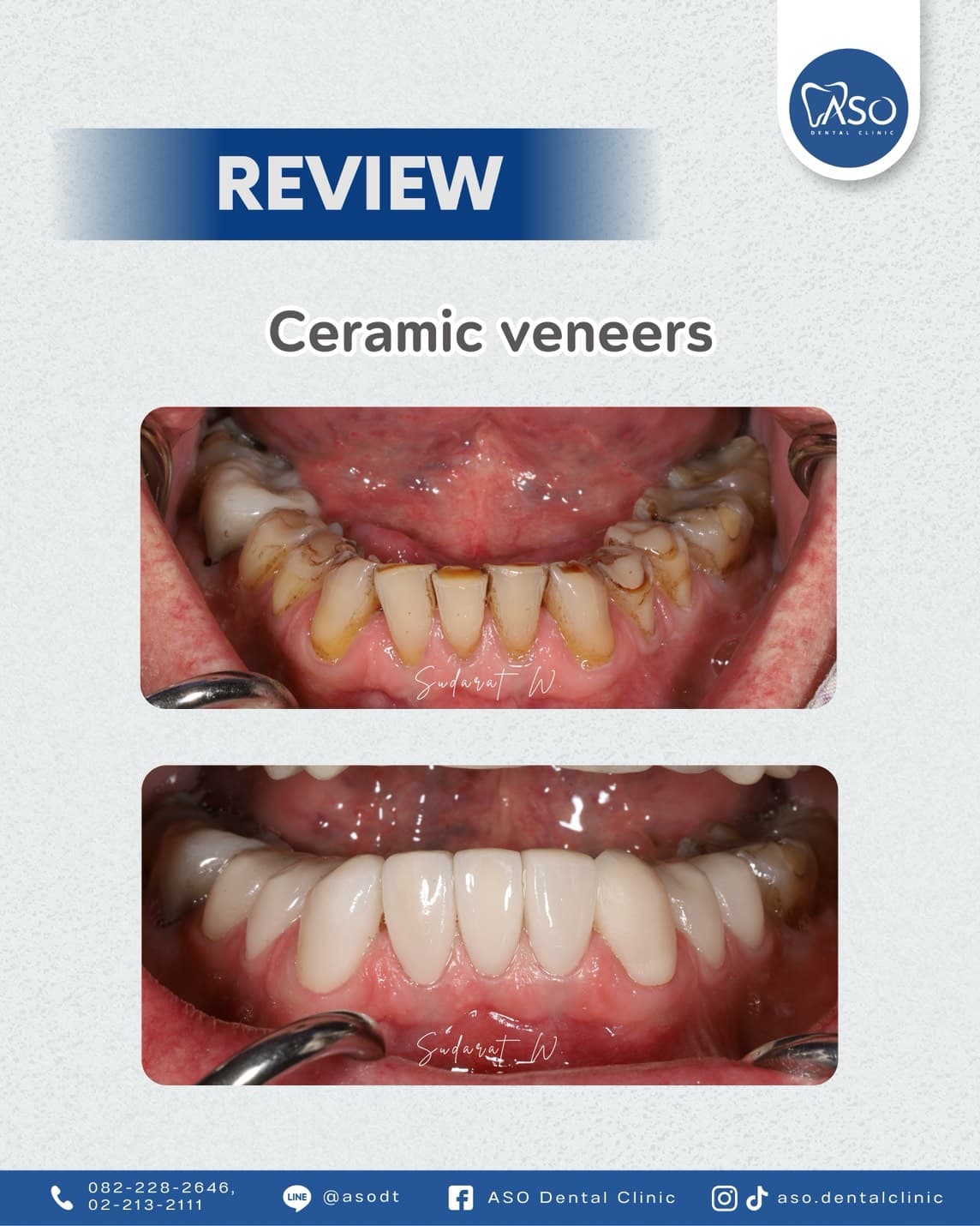 Ceramic veneers transformation